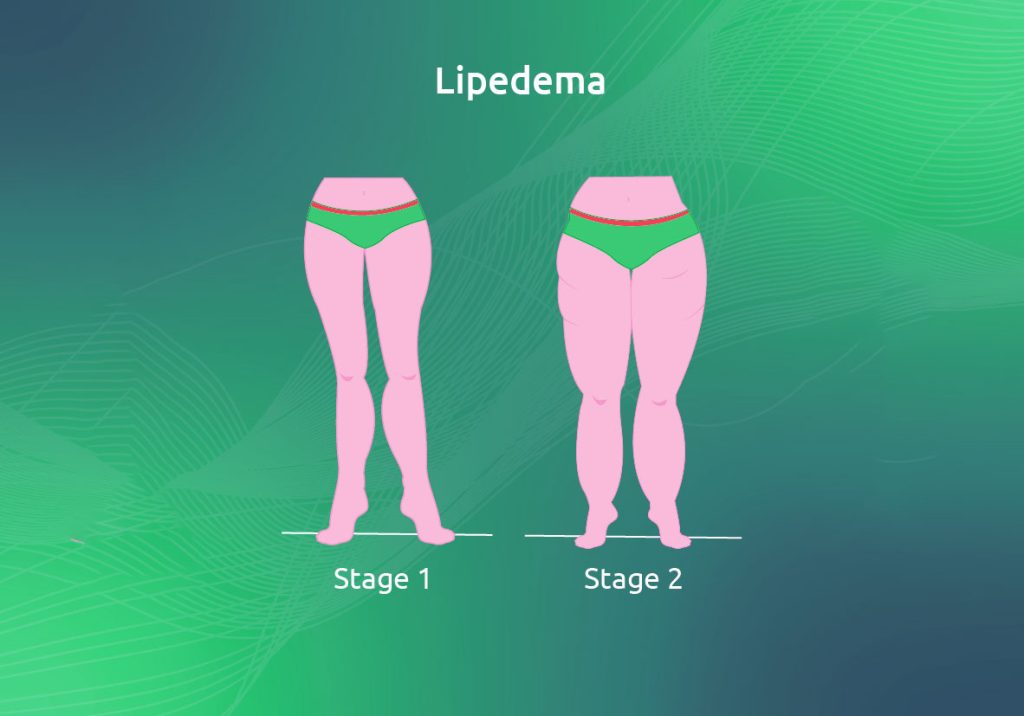 Lipedema1