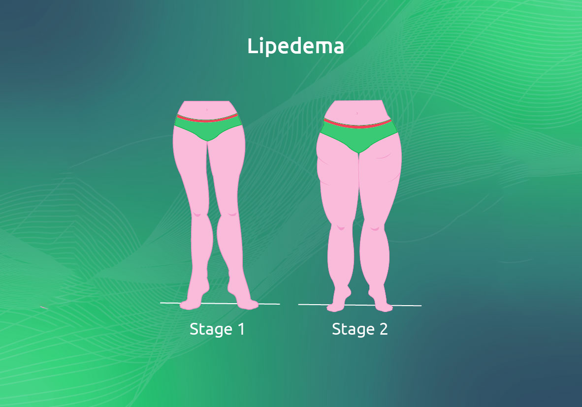 Lipedema1